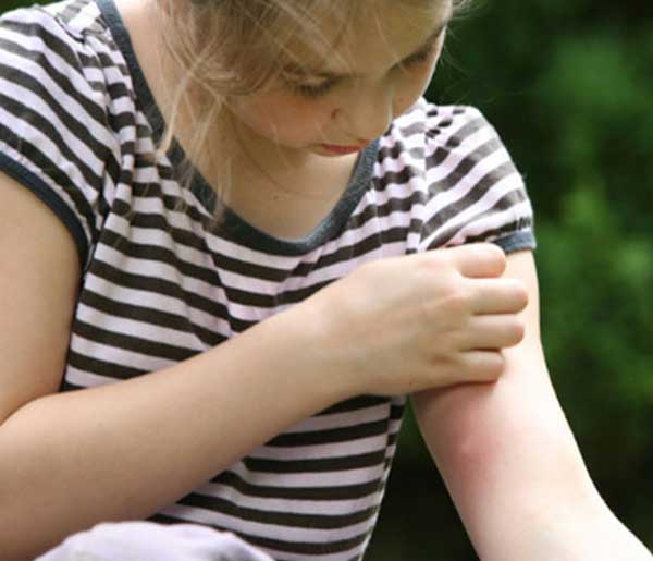 Girl scratching a mosquito bite.